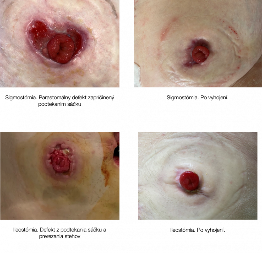 Odborné články / Najväčším postrachom stomika je komplikácia… - foto Odborné články / Najväčším postrachom stomika je komplikácia… - foto