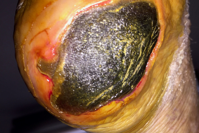 Liečenie dekubitov – foto materiál / Ukážky z praxe – liečenie dekubitov - foto Liečenie dekubitov – foto materiál / Ukážky z praxe – liečenie dekubitov - foto