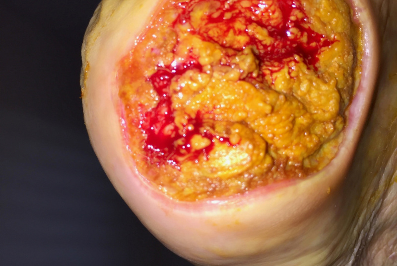 Liečenie dekubitov – foto materiál / Ukážky z praxe – liečenie dekubitov - foto Liečenie dekubitov – foto materiál / Ukážky z praxe – liečenie dekubitov - foto