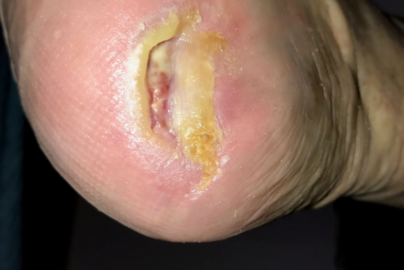 Liečenie dekubitov – foto materiál / Ukážky z praxe – liečenie dekubitov - foto Liečenie dekubitov – foto materiál / Ukážky z praxe – liečenie dekubitov - foto