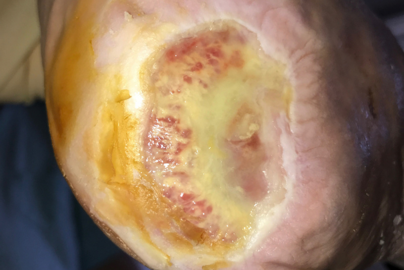 Liečenie dekubitov – foto materiál / Ukážky z praxe – liečenie dekubitov - foto Liečenie dekubitov – foto materiál / Ukážky z praxe – liečenie dekubitov - foto