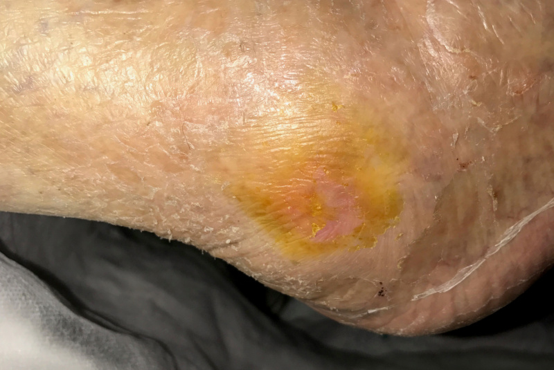 Liečenie dekubitov – foto materiál / Členok a nart – dekubit od posteľnej zábrany pri nedostatočnom polohovaní u rovnakej pacientky a jeho postupné liečenie. - foto Liečenie dekubitov – foto materiál / Členok a nart – dekubit od posteľnej zábrany pri nedostatočnom polohovaní u rovnakej pacientky a jeho postupné liečenie. - foto