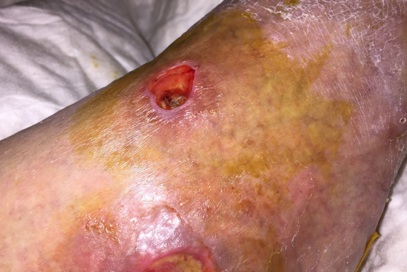 Liečenie dekubitov – foto materiál / Členok a nart – dekubit od posteľnej zábrany pri nedostatočnom polohovaní u rovnakej pacientky a jeho postupné liečenie. - foto Liečenie dekubitov – foto materiál / Členok a nart – dekubit od posteľnej zábrany pri nedostatočnom polohovaní u rovnakej pacientky a jeho postupné liečenie. - foto