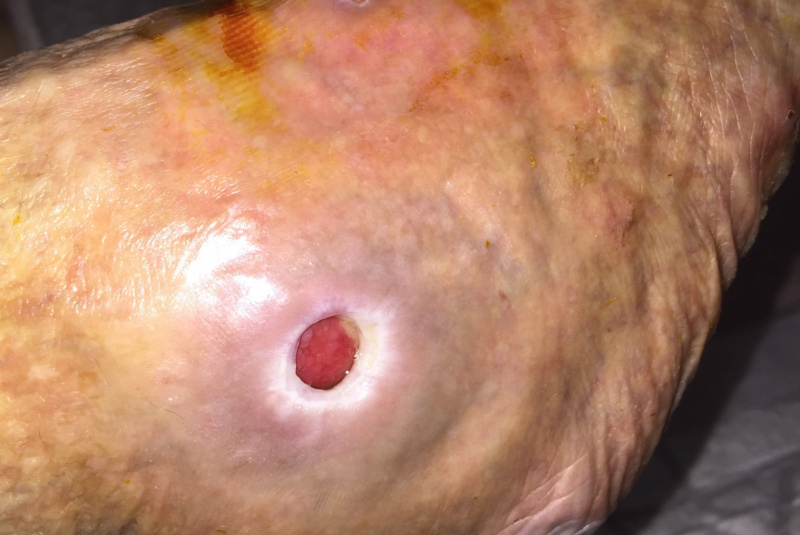 Liečenie dekubitov – foto materiál / Členok a nart – dekubit od posteľnej zábrany pri nedostatočnom polohovaní u rovnakej pacientky a jeho postupné liečenie. - foto Liečenie dekubitov – foto materiál / Členok a nart – dekubit od posteľnej zábrany pri nedostatočnom polohovaní u rovnakej pacientky a jeho postupné liečenie. - foto