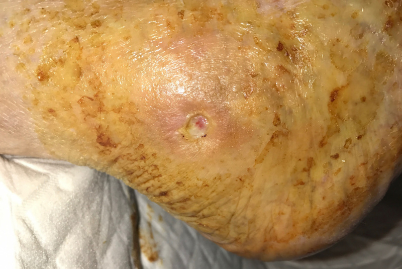 Liečenie dekubitov – foto materiál / Členok a nart – dekubit od posteľnej zábrany pri nedostatočnom polohovaní u rovnakej pacientky a jeho postupné liečenie. - foto Liečenie dekubitov – foto materiál / Členok a nart – dekubit od posteľnej zábrany pri nedostatočnom polohovaní u rovnakej pacientky a jeho postupné liečenie. - foto