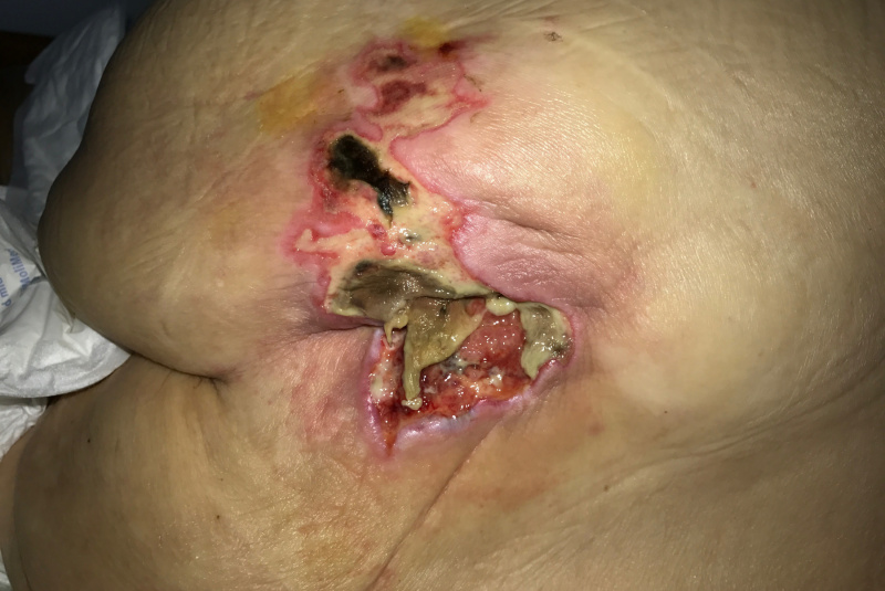 Liečenie dekubitov – foto materiál / Dekubit v krížovej oblasti u 92 ročnej pacientky po cievnej príhode, nepolohovaná, dehydrovaná a postupné liečenie dekubitov. - foto Liečenie dekubitov – foto materiál / Dekubit v krížovej oblasti u 92 ročnej pacientky po cievnej príhode, nepolohovaná, dehydrovaná a postupné liečenie dekubitov. - foto