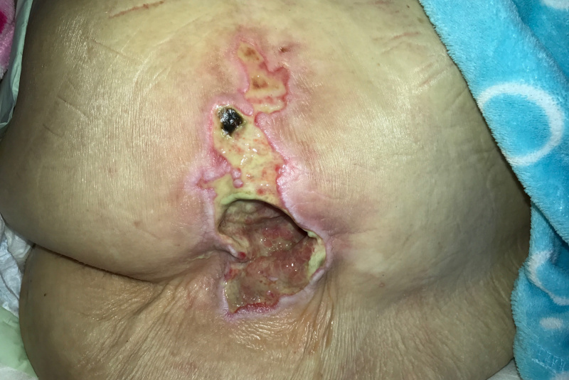 Liečenie dekubitov – foto materiál / Dekubit v krížovej oblasti u 92 ročnej pacientky po cievnej príhode, nepolohovaná, dehydrovaná a postupné liečenie dekubitov. - foto Liečenie dekubitov – foto materiál / Dekubit v krížovej oblasti u 92 ročnej pacientky po cievnej príhode, nepolohovaná, dehydrovaná a postupné liečenie dekubitov. - foto