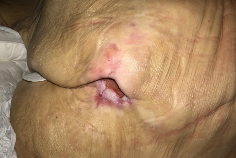 Liečenie dekubitov – foto materiál / Dekubit v krížovej oblasti u 92 ročnej pacientky po cievnej príhode, nepolohovaná, dehydrovaná a postupné liečenie dekubitov. - foto Liečenie dekubitov – foto materiál / Dekubit v krížovej oblasti u 92 ročnej pacientky po cievnej príhode, nepolohovaná, dehydrovaná a postupné liečenie dekubitov. - foto