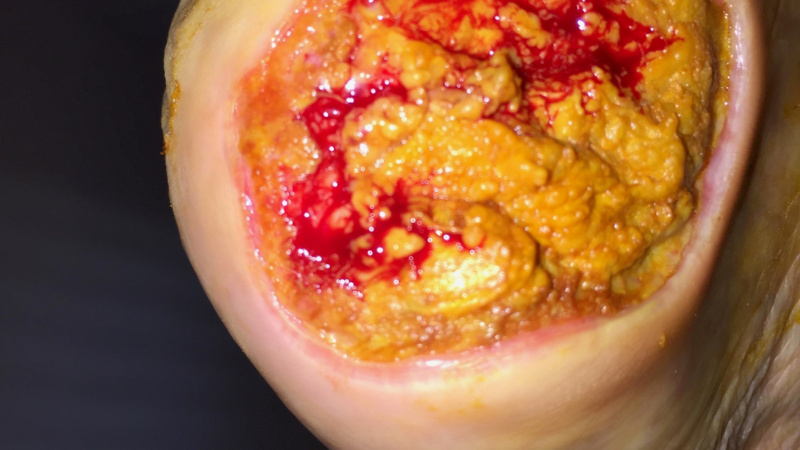 Liečenie dekubitov – foto materiál / Výsledok liečenia dekubitov - pred a po - foto Liečenie dekubitov – foto materiál / Výsledok liečenia dekubitov - pred a po - foto