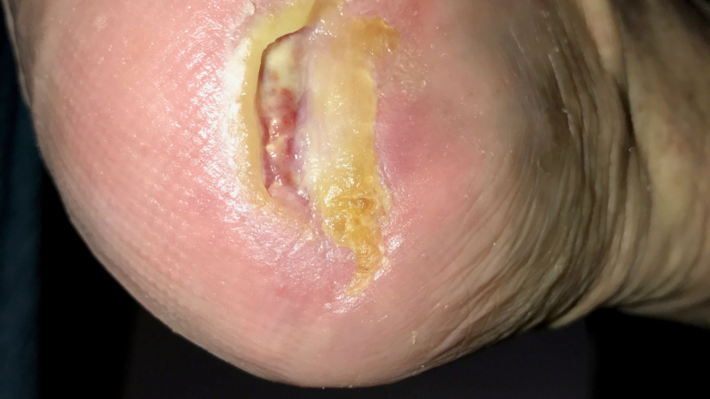 Liečenie dekubitov – foto materiál / Výsledok liečenia dekubitov - pred a po - foto Liečenie dekubitov – foto materiál / Výsledok liečenia dekubitov - pred a po - foto